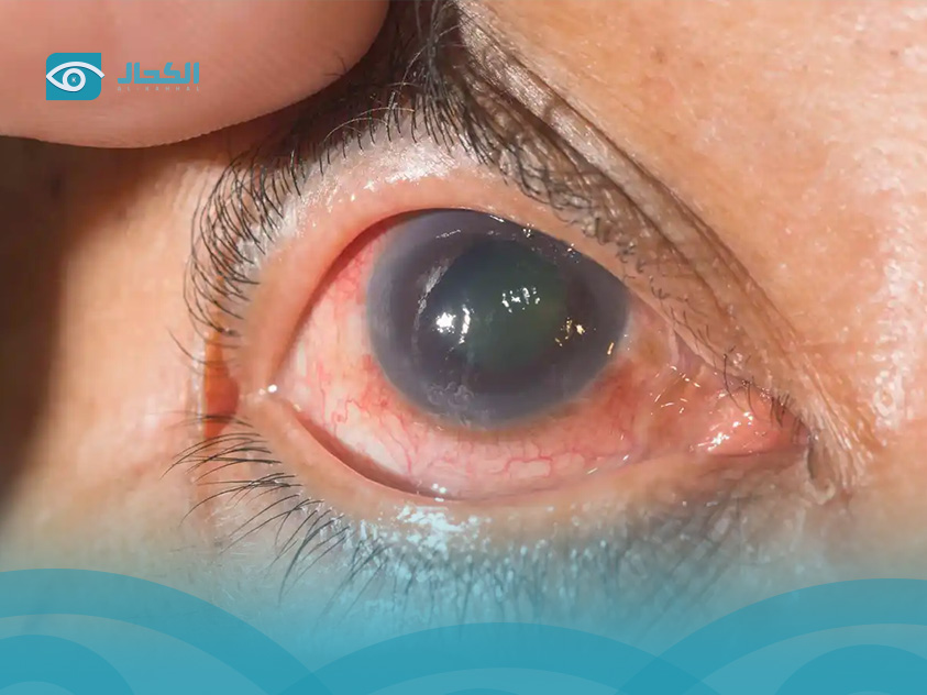 glaucoma-treatment