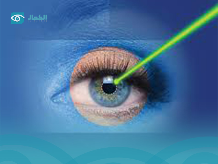 Laser Vision Correction