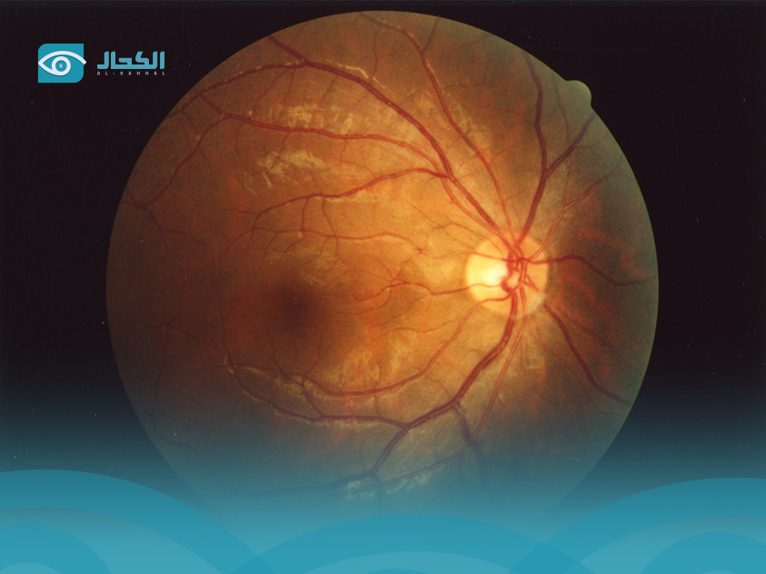 تكلفة جراحة الساد بالليزر في مصر