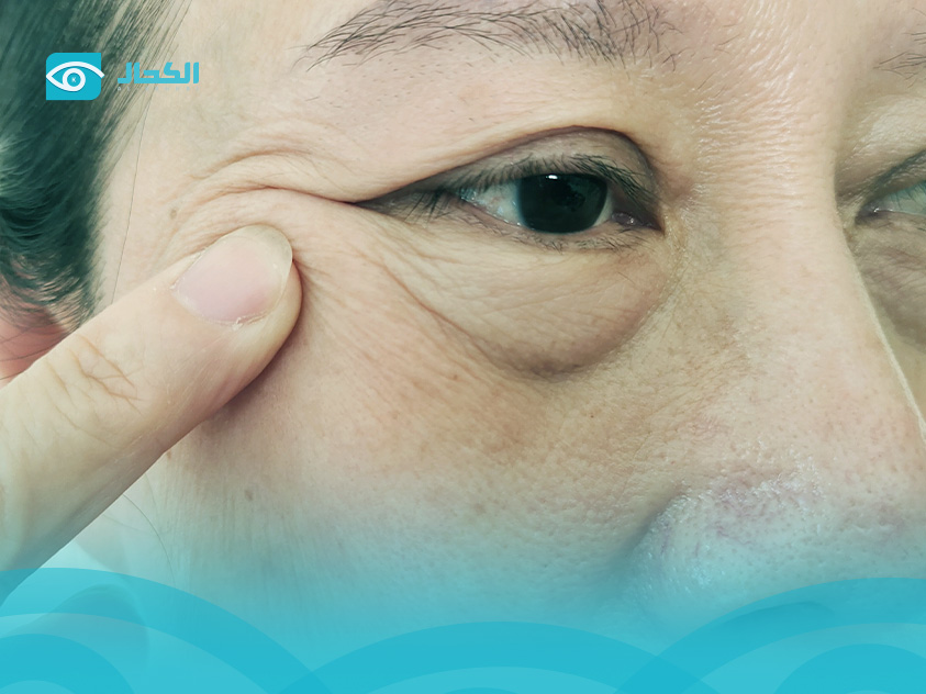 Al Kahhal protocol for Keratitis treatment