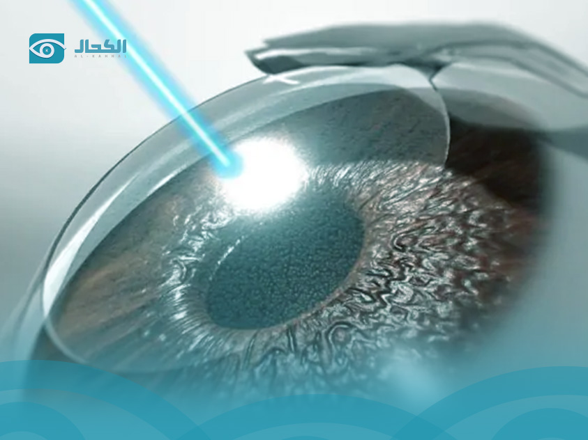 السن المناسب لجراحة العيون بالليزر