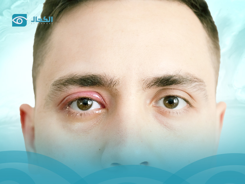 التهاب الجفون العين