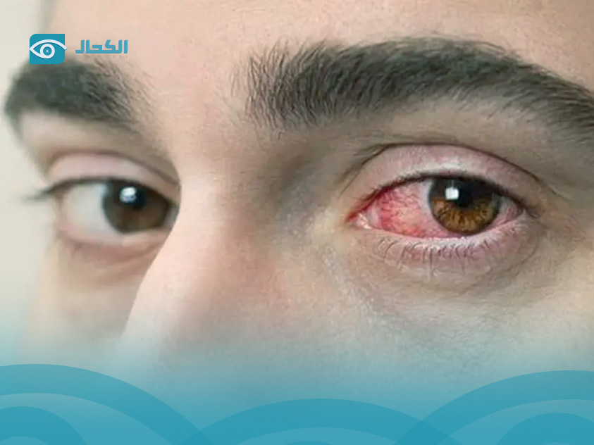 سبب انفجار الشرايين