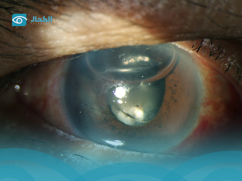 عملية- الماء- الابيض